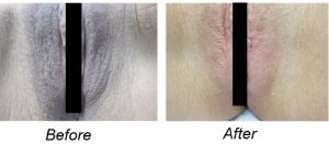 Anal Bleaching Transformation: Before & After Insights